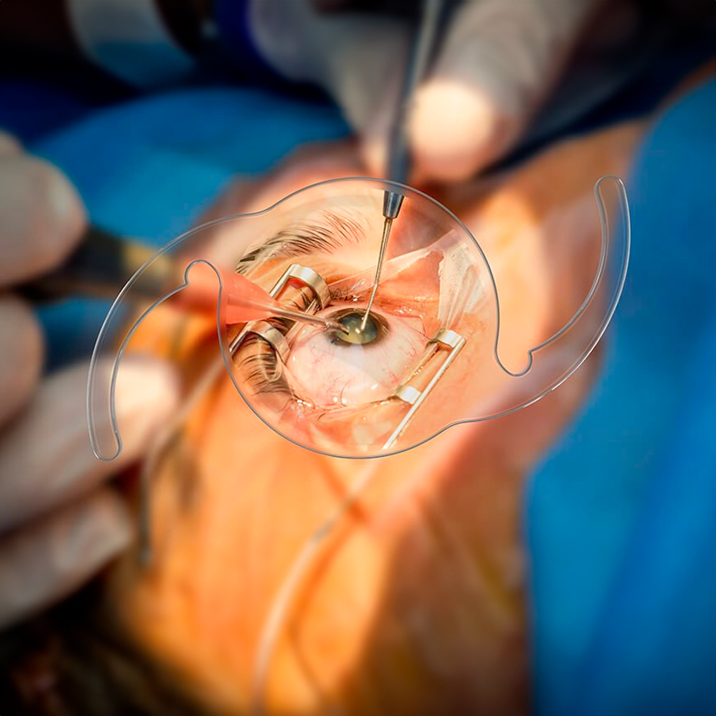 Cirugía Refractiva con Lentes Intraoculares